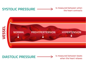 Blood-pressure-300x237