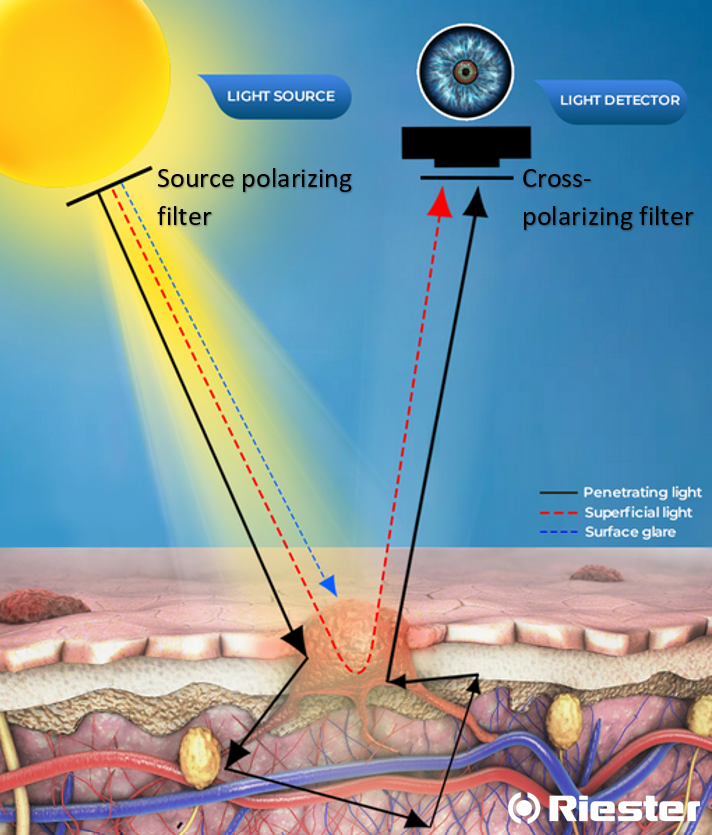 Polarised-dermoscopy-Riester-1