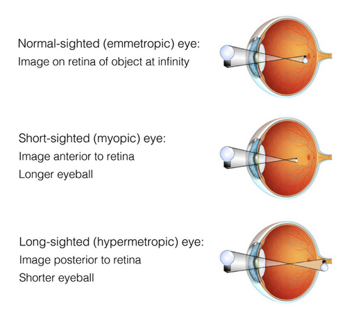 Riester-Ametropias-Updated-04-500x456-1
