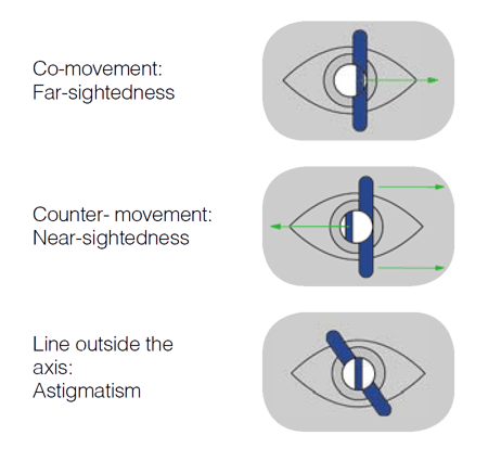 Streak-retinoscope-schematic-example-RevisedV4