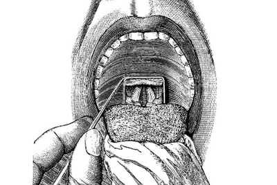 Mirror-lagyngoscopy